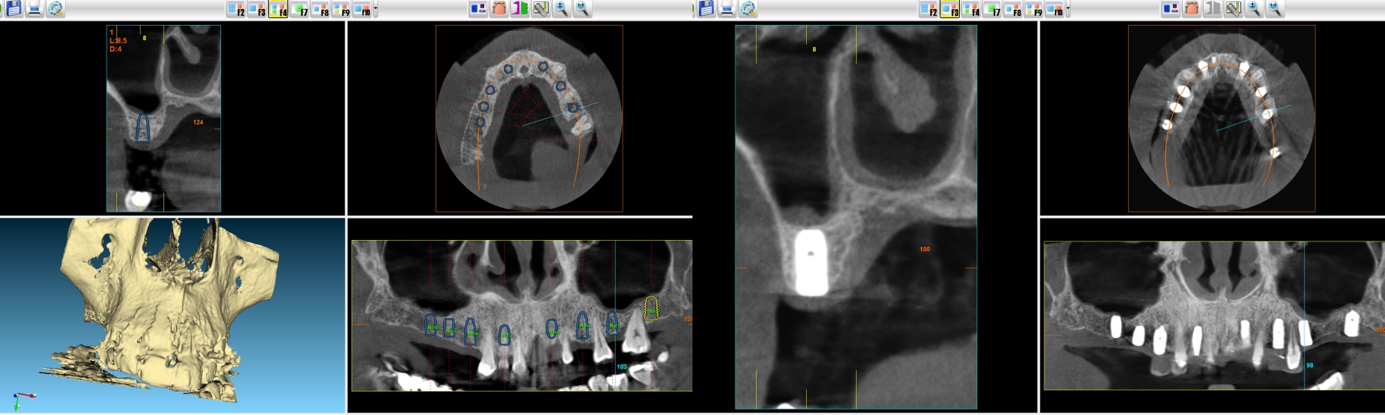 implantologija