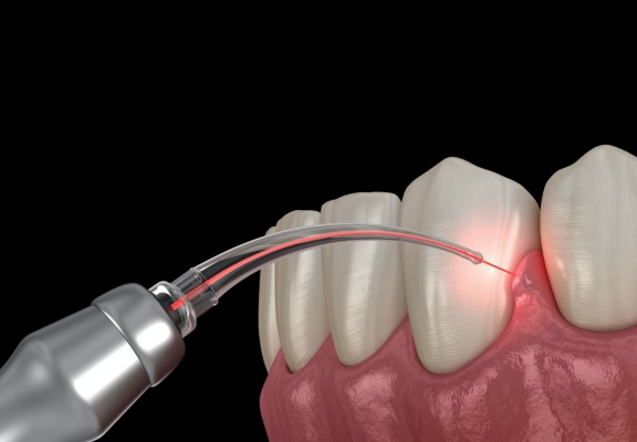 Laser u dentalnoj medicini