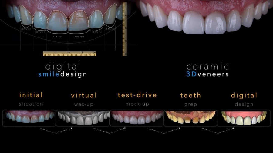 Digital smile design